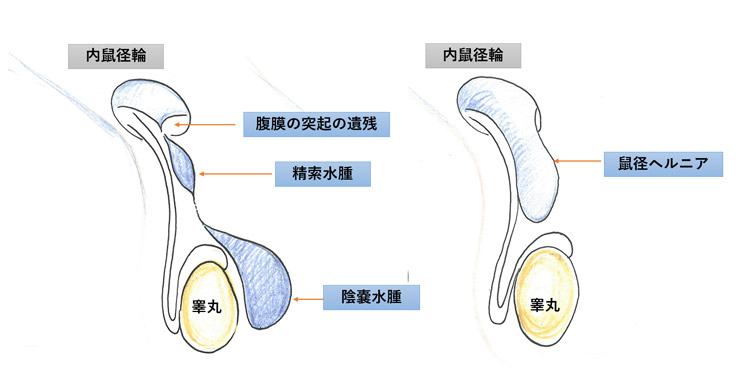 鼠径ヘルニアの画像検査