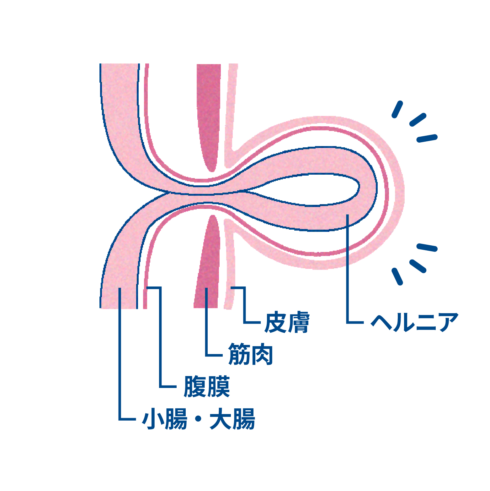 そけいヘルニアの状態