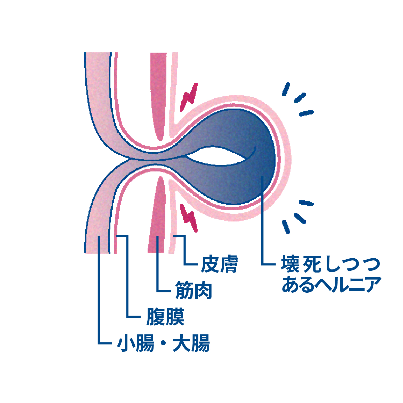 壊死しつつあるそけいヘルニアの状態