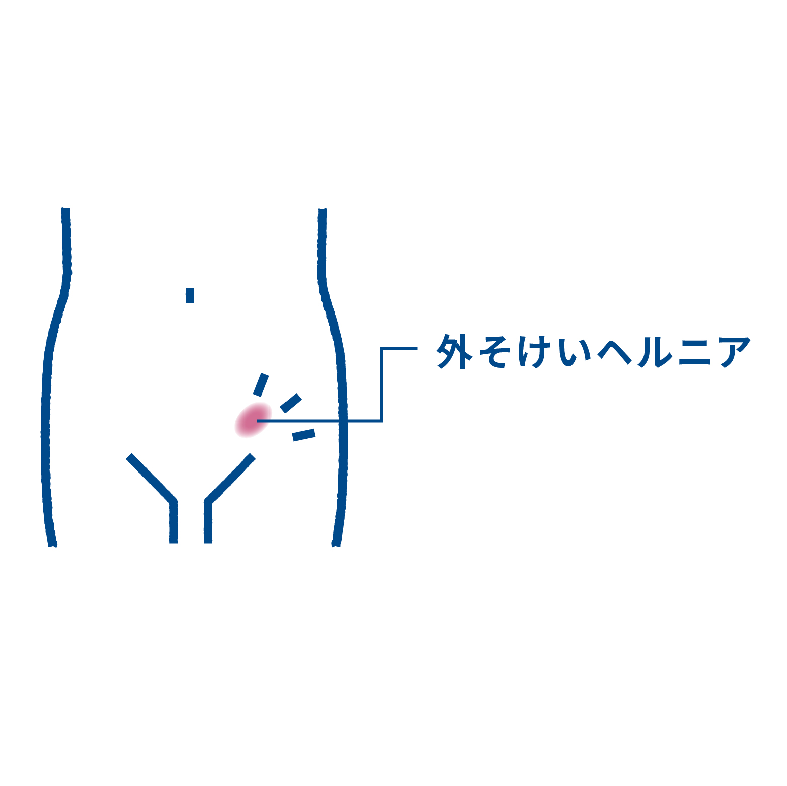 外そけいヘルニア