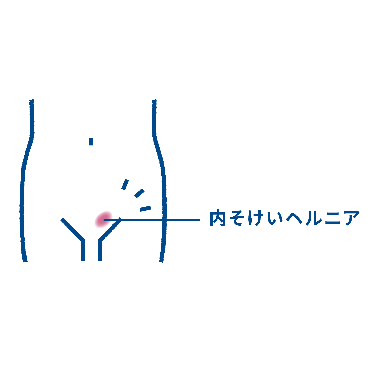 内そけいヘルニア