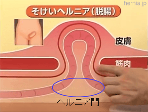 メッシュを使った脱腸の治療イメージ