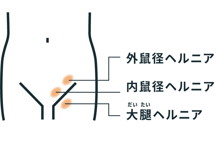 鼠径部ヘルニア 脱腸 とは そけいヘルニアノート