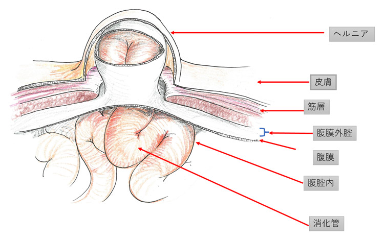 鼠径部ヘルニア:図解