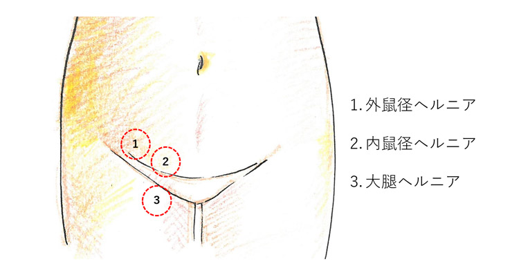 鼠径部ヘルニア