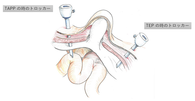 動画でわかる腹腔鏡下鼠径部ヘルニア修復術ーTAPP法のすべてー